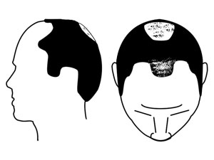 Hair loss image